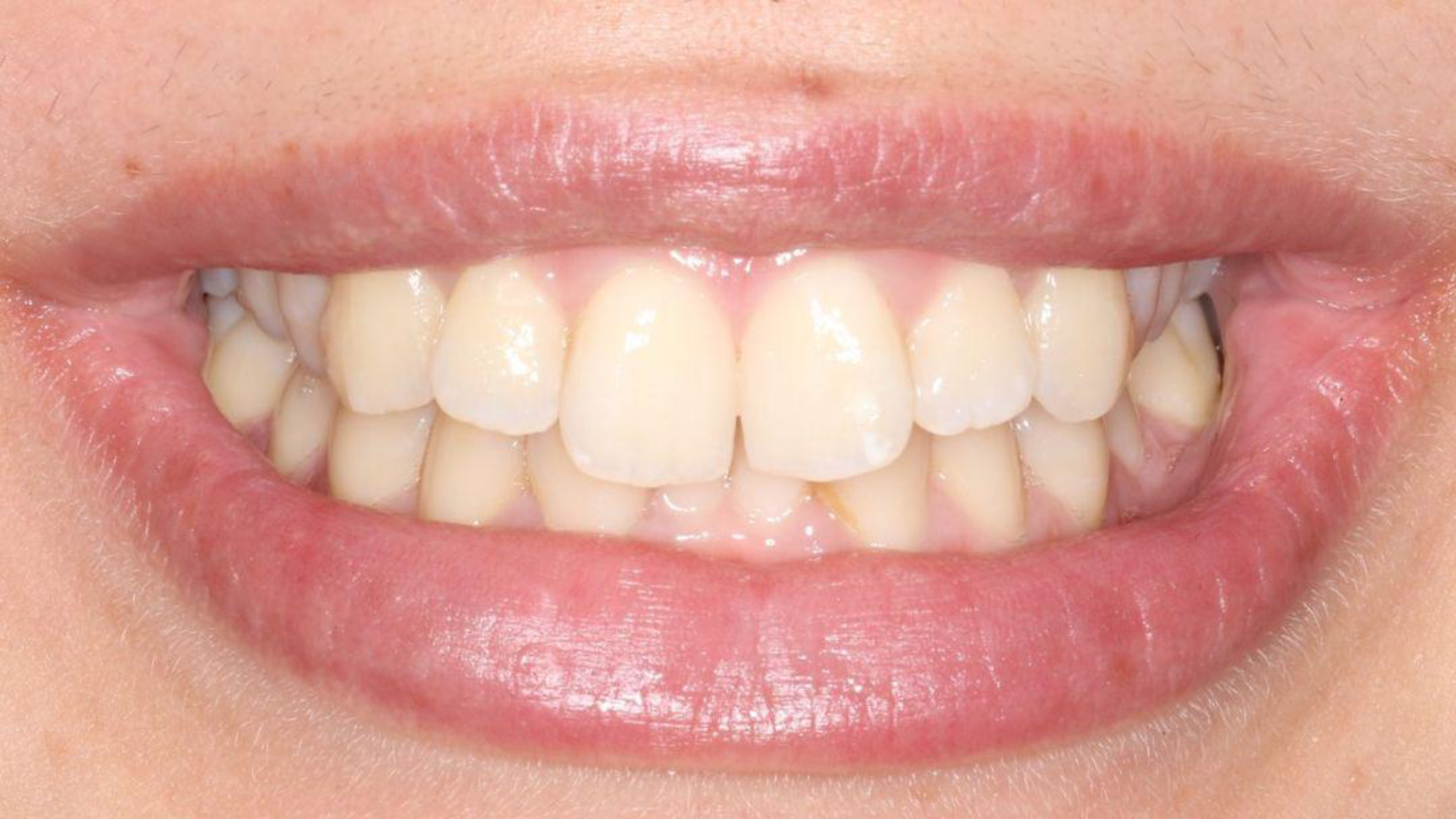 Starting smile photograph used for an illustrative shade comparison.