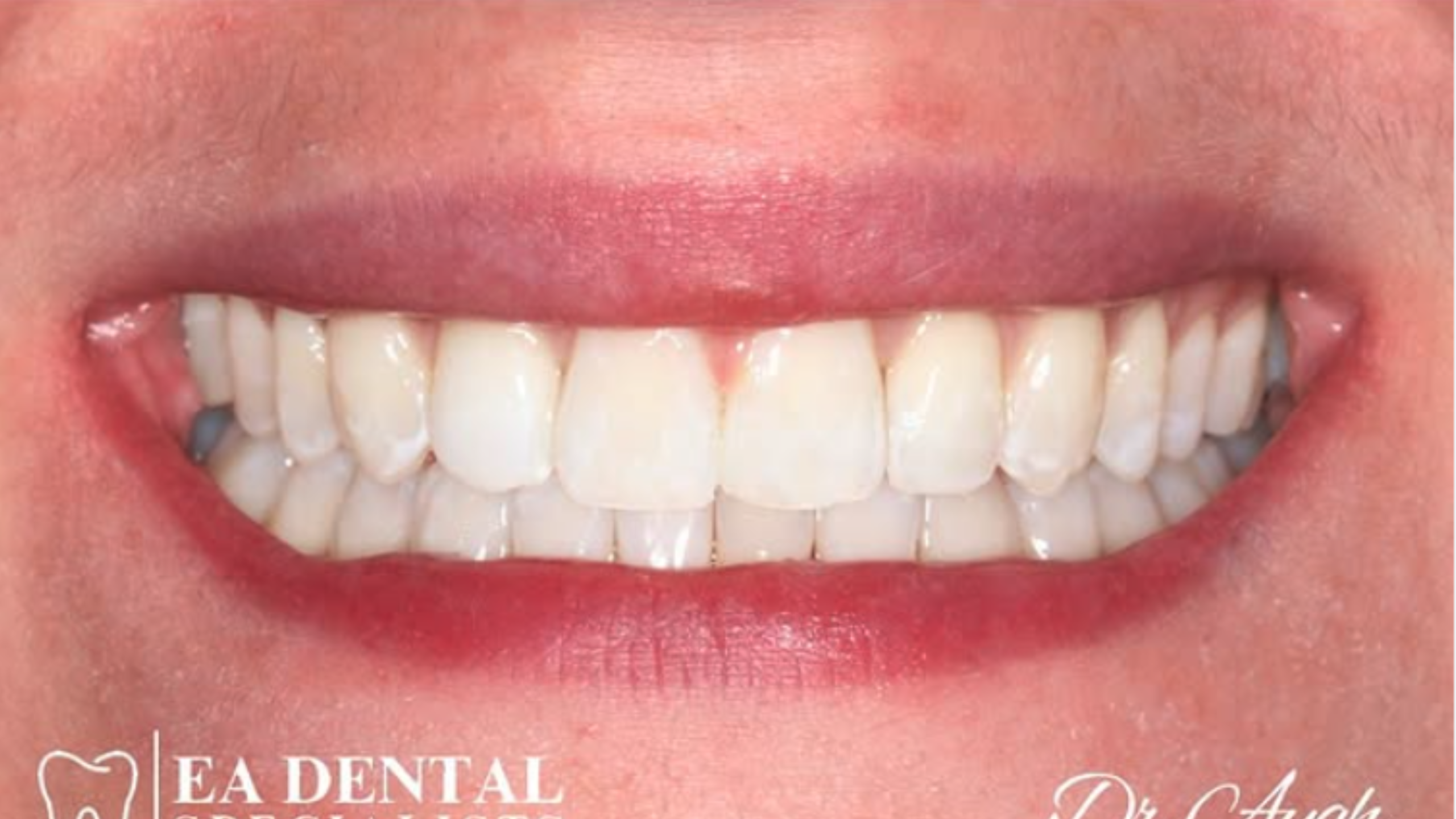 Close-up of the same patient's smile after treatment, with the upper front teeth together.