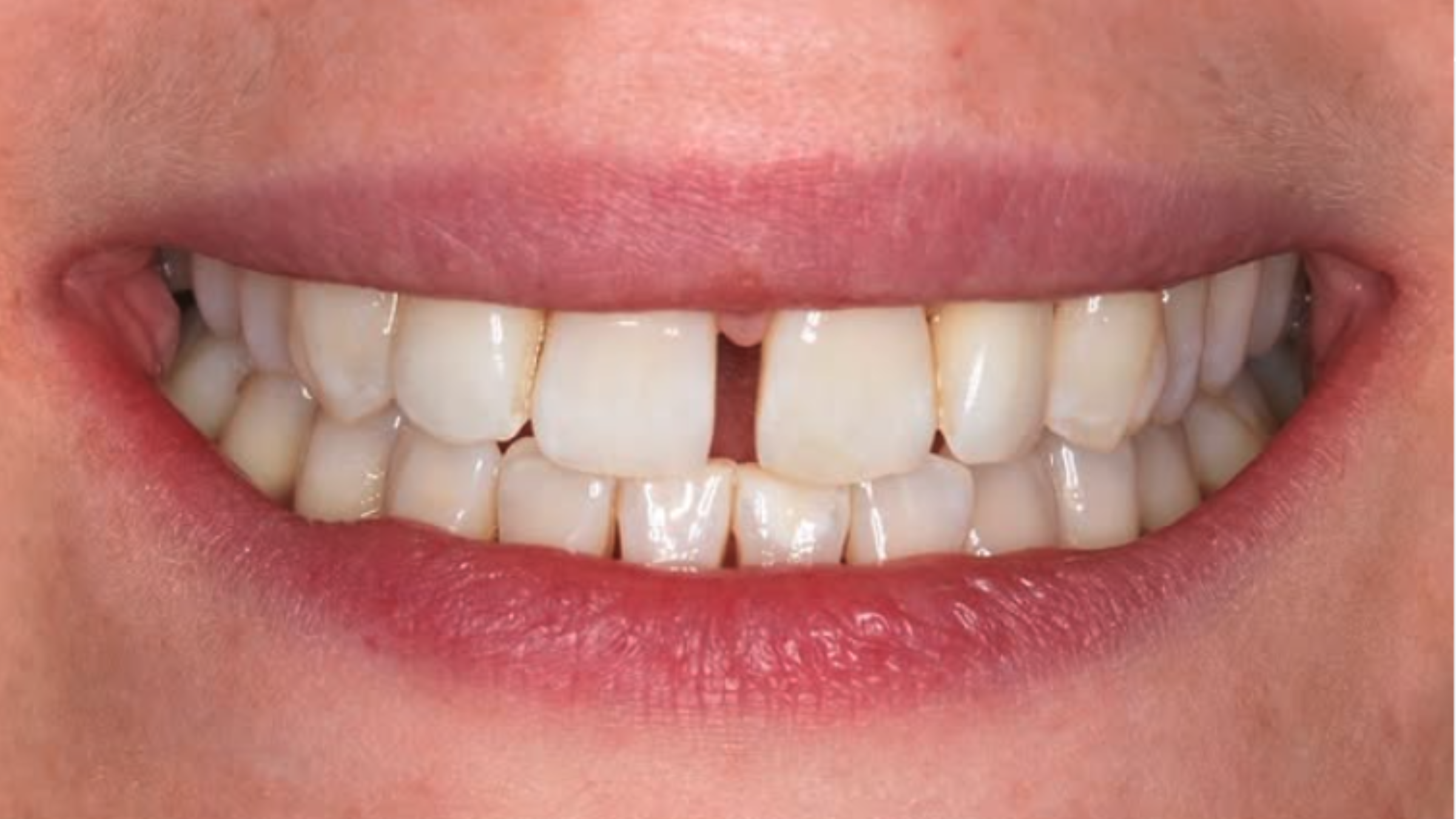 Close-up of the second patient's smile before treatment, with a gap between the upper front teeth.