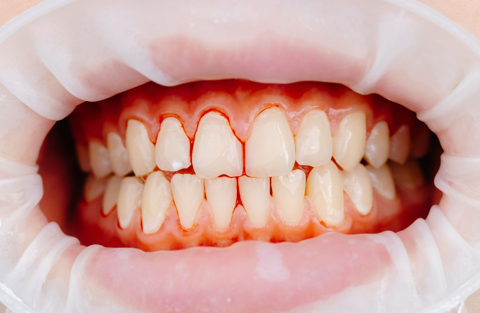 A close view of teeth and gums during a dental assessment.