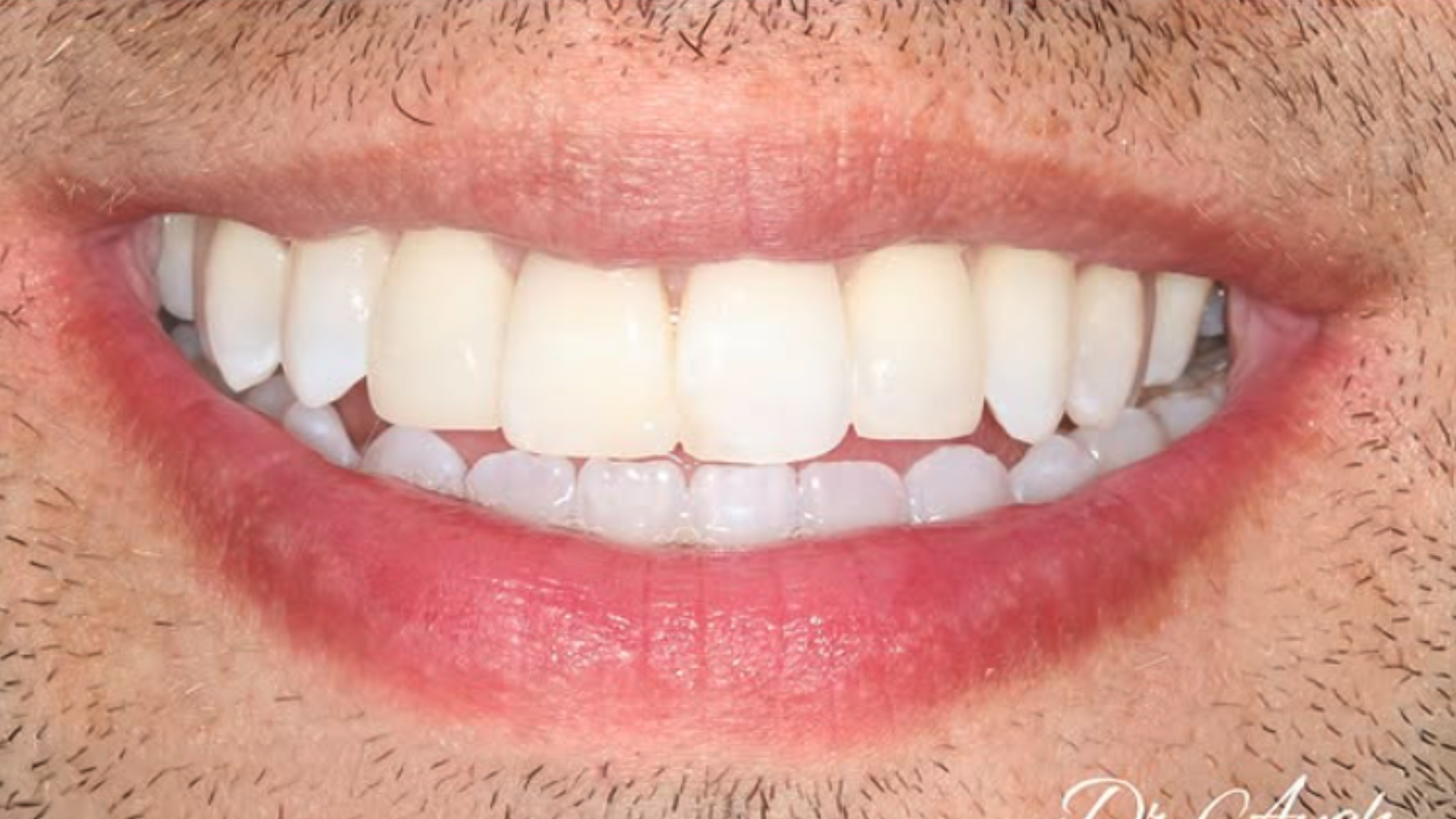 The same adult smile after treatment, with the upper front teeth together, from EA Dental's clear-aligner gallery.