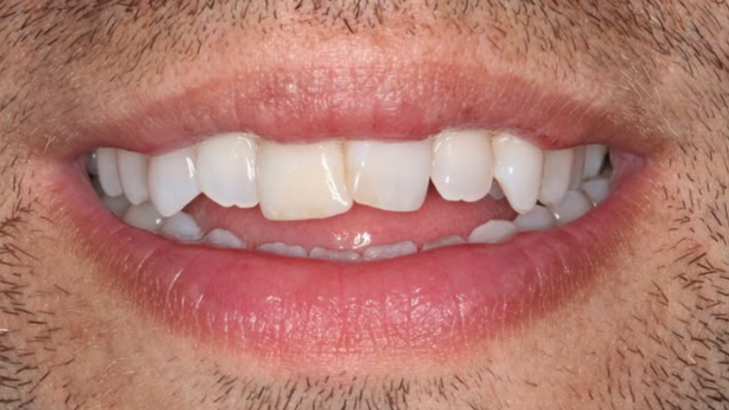 An adult smile before treatment, with spaces between the upper front teeth, from EA Dental's clear-aligner gallery.