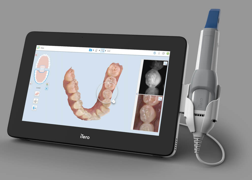An iTero digital scanner and handheld scanning wand, with a three-dimensional dental scan on its screen.